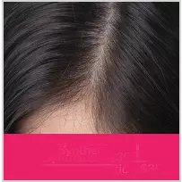 Implant hair